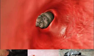 Rùng rợn cảnh giòi làm ổ, ăn thịt sống dưới da người