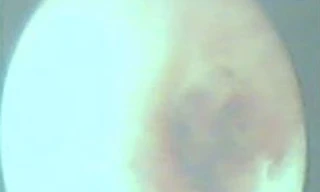 Kiến làm tổ trong… tai thiếu nữ