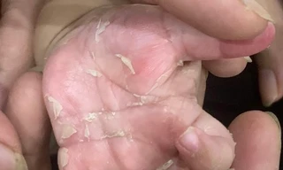 Nguyên nhân không ngờ khiến bé trai 3 tháng tuổi mắc bệnh giang mai