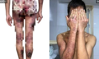 Nam thanh niên'nát hết người' vì chế biến kiến ba khoang thành dung dịch chữa ngứa