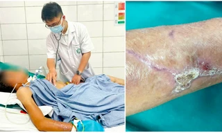 Cứng hàm, suy hô hấp vì vết xước nhỏ, cảnh báo 'đặc biệt' từ hai ca uốn ván nặng