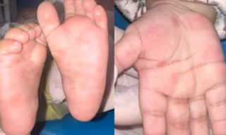 Bé 4 tháng tuổi bị bệnh giang mai bẩm sinh