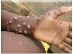 Nóng: Dịch đậu mùa khỉ gia tăng, Bộ trưởng Bộ Y tế yêu cầu ngăn chặn từ cơ sở y tế, cửa khẩu