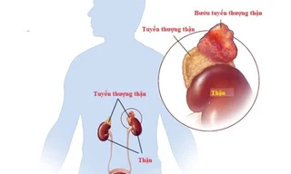 Nguy cơ từ u tuyến thượng thận: Người trẻ tăng huyết áp không rõ nguyên nhân cần cảnh giác