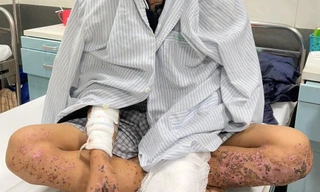 Mù mắt, cháy sém người vì dùng điện thoại khi sạc pin