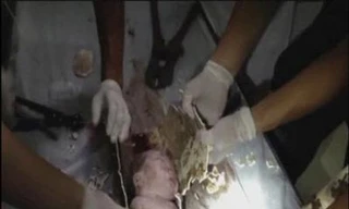 Các bác sỹ cẩn thận gỡ ống để cứu bé sơ sinh