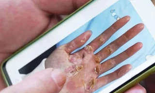 Bức ảnh bàn tay biến dạng của vận động viên