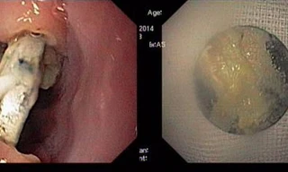 Kinh hoàng bé 2 tuổi bị hóc pin trong thực quản 
