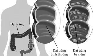 Mô phỏng đại tràng bình thường và đại tràng bị viêm