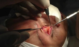 Kinh hoàng silicon chui lên hốc mắt