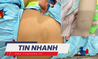 TIN NHANH: Đình chỉ cơ sở giữ trẻ sau vụ bé gái hơn 2 tuổi bị chấn thương 'vùng kín'
