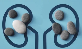 Sỏi thận hình thành như thế nào?