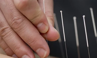 Châm cứu giúp cải thiện bệnh Parkinson