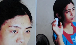 Chị Duyên với những vết thương sau khi bị cô em chồng đánh đập