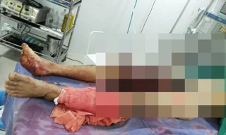 Một nạn nhân vụ lật xe công nông đang được điều trị tại bệnh viện 115 Nghệ An.