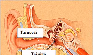 Thủng màng nhĩ do viêm tai giữa