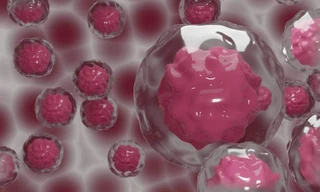 Ung thư buồng trứng khó phát hiện ở giải đoạn đầu,