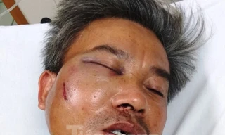 Nạn nhân Lê Song Toàn bị đánh gãy hàm, vỡ xoang, tỷ lệ thương tật 22%.