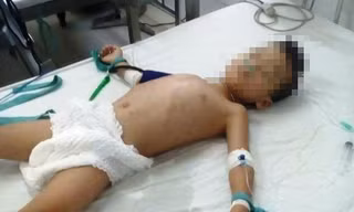 Cháu L. điều trị tại bệnh viện trong tình trạng nguy kịch tính mạng