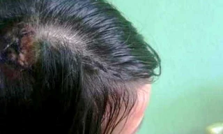 Nữ tài xế Trần Thị Như Băng với với rách lớn ở đầu, do bị bảo vệ Bệnh viện Đại học Y dược Huế đánh đập