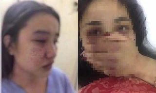 Sức khỏe nữ nhân viên nghi bị bác sĩ Bệnh viện T.Ư Huế hành hung hiện ra sao?