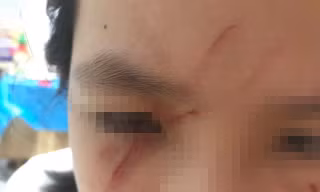 Ba giáo viên ở Hà Nội bị kỷ luật vì để nữ sinh lớp 5 bị bạn đánh rách mặt trong lớp học