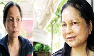 Cô gái 'hóa bà lão' lại bị lão hóa lần thứ 2