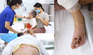 Các vị trí vết bỏng sâu nghiêm trọng của trẻ. Ảnh: BS cung cấp