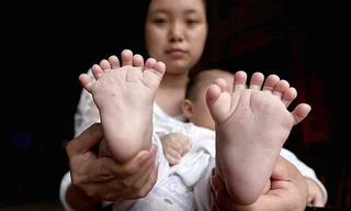 Theo Nhân dân Nhật báo, bé Hồng Hồng 3 tháng tuổi có tới 31 ngón tay và chân, đặc biệt không có ngón tay cái.