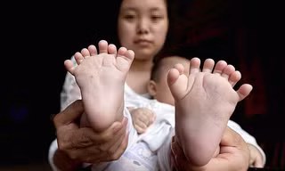 Theo Nhân dân Nhật báo, bé Hồng Hồng 3 tháng tuổi có tới 31 ngón tay và chân, đặc biệt không có ngón tay cái.