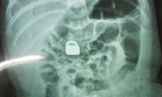 Hình chụp X-quang cho thấy chiếc ổ khóa nằm gọn trong bụng của bé 2 tháng tuổi