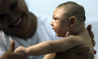 Bé Juan Pedro mắc chứng đầu nhỏ vì Zika ở Recife, Brazil
