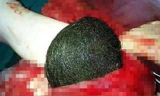 Búi tóc được đưa ra khỏi bụng bệnh nhân.