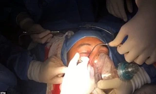 Các bác sỹ phẫu thuật lấy lựu đạn ra khỏi mặt binh sỹ