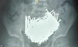 Hình chụp CT cho thấy 200 chiếc đinh nằm trong bụng cậu bé 15 tuổi