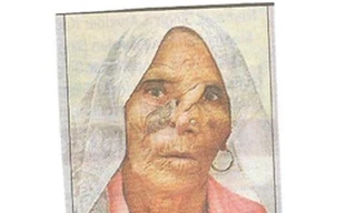 Phát hiện hơn 100 con giòi trong mũi bệnh nhân