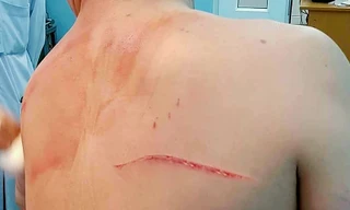 Vết chém kéo dài trên lưng bác sĩ Chiêm Quốc Thái.