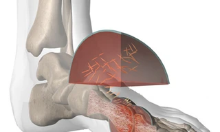 Biểu hiện của bệnh gút