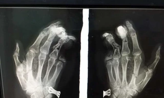  Phim chụp X-quang cho thấy ngón út của bệnh nhân bị mất 2 đốt.
