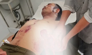 N.H.S bị dập nát bàn tay trái.