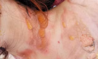 Vết thương trên người D.