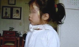  Bé gái bốn tuổi có 2 bộ phận sinh dục nam, nữ 