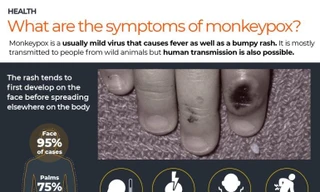 Phòng chống bệnh đậu mùa khỉ: Việt Nam đề nghị WHO, Nhật, Mỹ hỗ trợ 