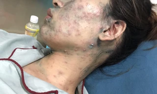 Nhiều người lớn mắc thủy đậu bị biến chứng nặng 