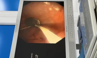 Cận cảnh gắp nắp lon nước ngọt trong dạ dày bé trai 11 tuổi