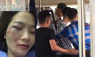 Chị H. bị nhóm thanh niên đánh thâm tím mặt.