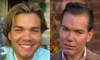 Khuôn mặt anh Rodrigo trước và sau thẩm mĩ.