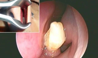 Ảnh chụp chiếc răng nằm trong hốc mũi nam thanh niên.