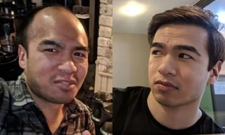 Châu Á: Đại dịch hói đầu khiến giới trẻ áp lực mỗi khi đi xin việc và kết hôn