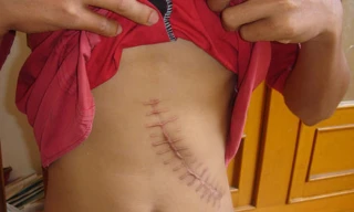 Do túng quẫn về kinh tế, nhiều người đã phải tìm đến các đường dây bán thận. Ảnh minh họa